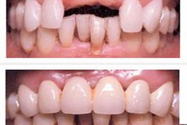 小女孩梦见自己牙掉了是什么预兆