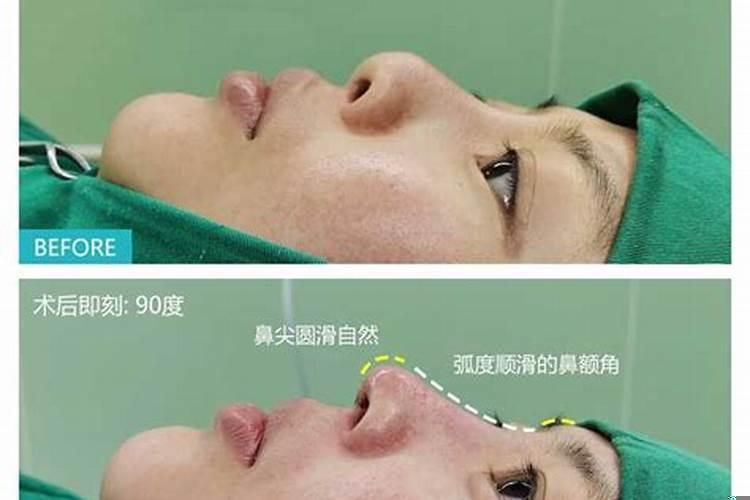 如何改掉朝天鼻
