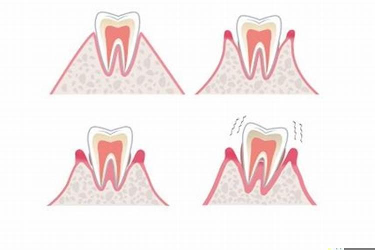 怀孕梦到牙齿松动是什么预兆