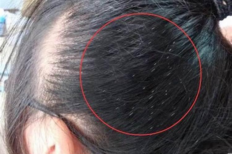 梦见孩子头上长虱子是什么意思