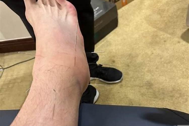 为什么左脚容易受伤