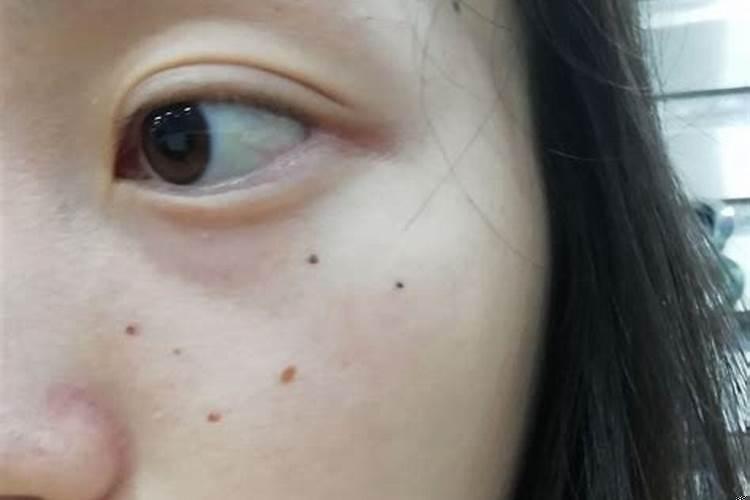 脸上有小痣怎么去掉