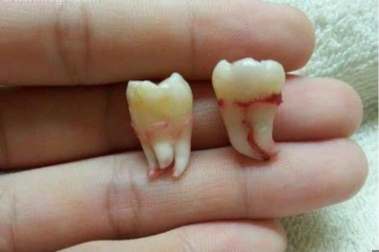 梦见牙齿被拔掉