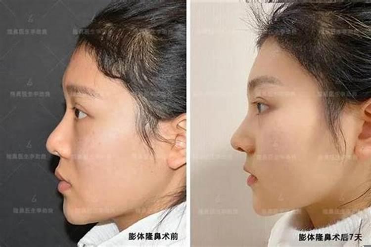 隆鼻会破坏运势吗