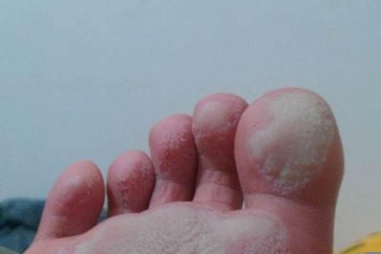 梦见脚上长个肉瘤