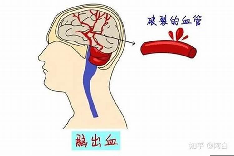 如何知道自己有没有脑溢血