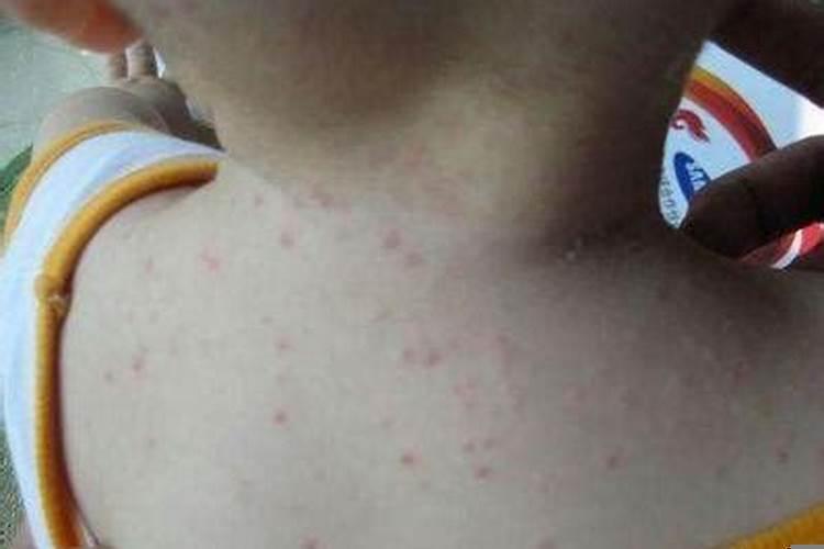 小孩风水疙瘩怎么治好得快