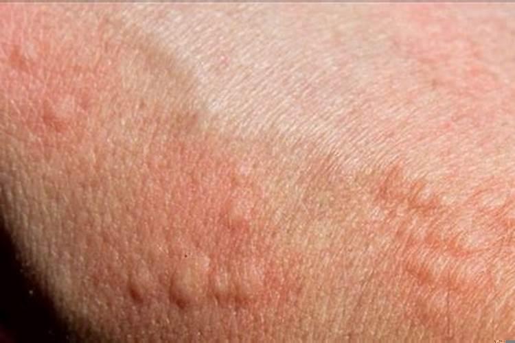 小孩风水疙瘩怎么治好得快